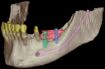 Digitale Volumentomographie bietet dem Behandlerteam den aktuell sichersten und höchsten Standard in der Röntgendiagnostik